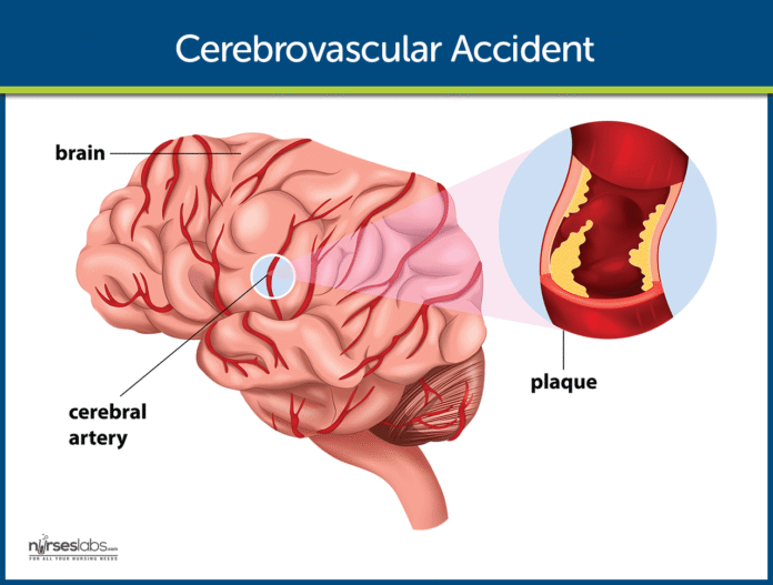 Cerebrovascular-Accident