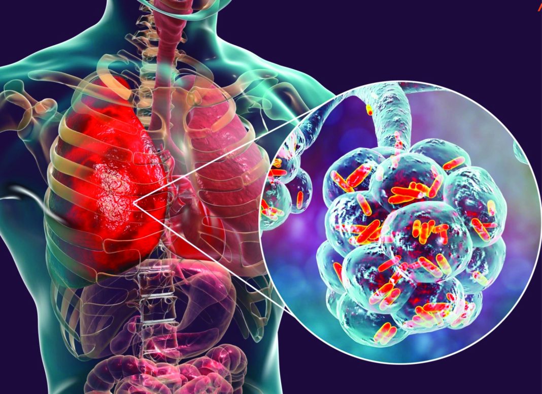 A study involving Eswatini researchers has found that advanced genetic sequencing can detect hidden drug-resistant tuberculosis, improving diagnosis and treatment outcomes.