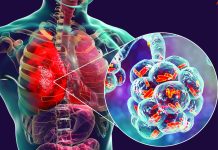 Local researchers expose hidden drug-resistant TB A study involving Eswatini researchers has found that advanced genetic sequencing can detect hidden drug-resistant tuberculosis, improving diagnosis and treatment outcomes.
