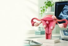 Everything you need to know about Fibroids
